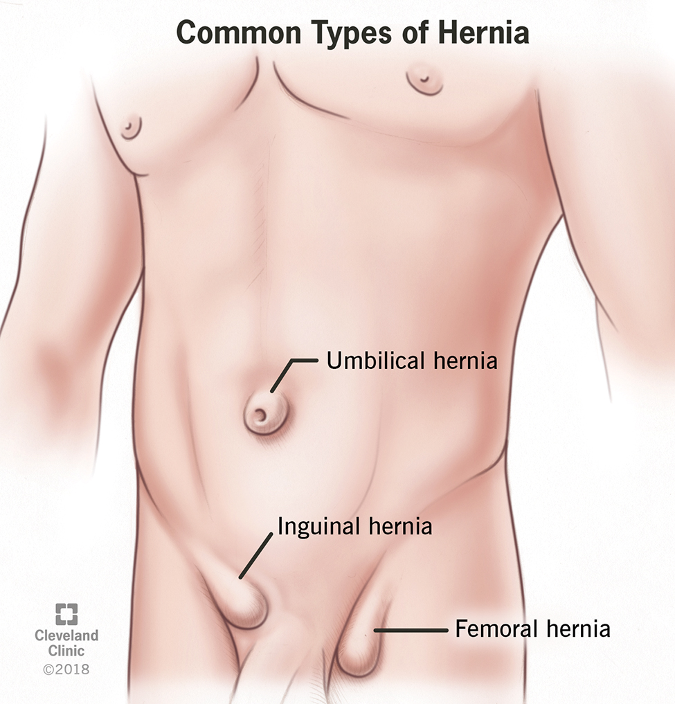 Depiction of Hernia | Sudha Hospital & Medical Research Centre