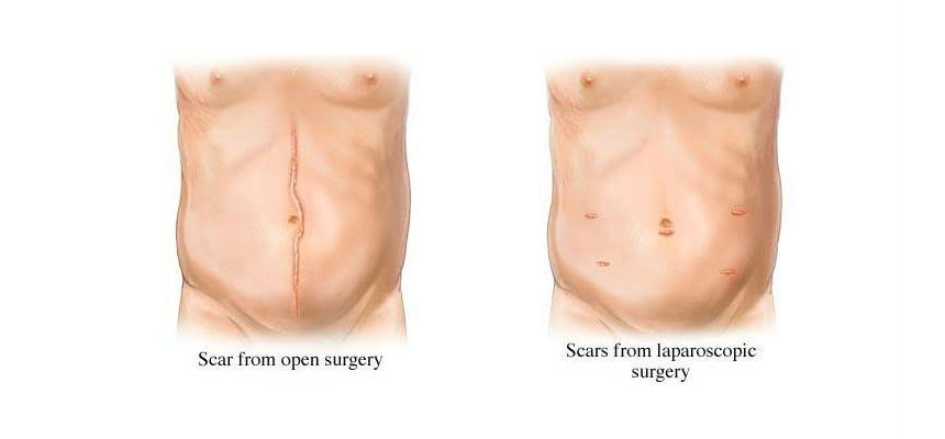 depiction of Difference between laparoscopy surgery and general surgery scar | Sudha Hospital - Kota