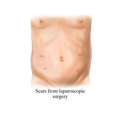 scars-from-laparoscopy-surgery